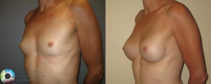 Before & After Breast Augmentation Case 369 View #2 in Denver and Colorado Springs, CO