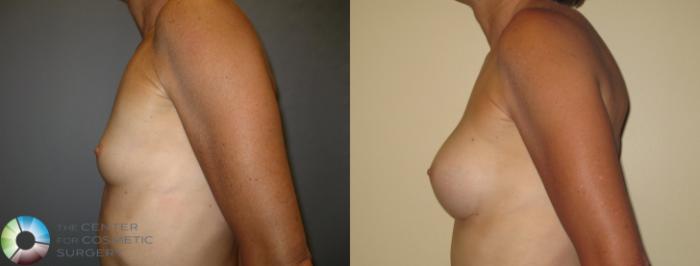 Before & After Breast Augmentation Case 369 View #3 in Denver and Colorado Springs, CO