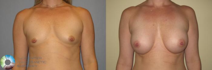 Before & After Breast Augmentation Case 371 View #1 in Denver and Colorado Springs, CO