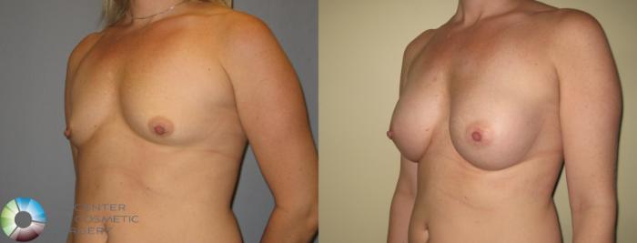 Before & After Breast Augmentation Case 371 View #2 in Denver and Colorado Springs, CO