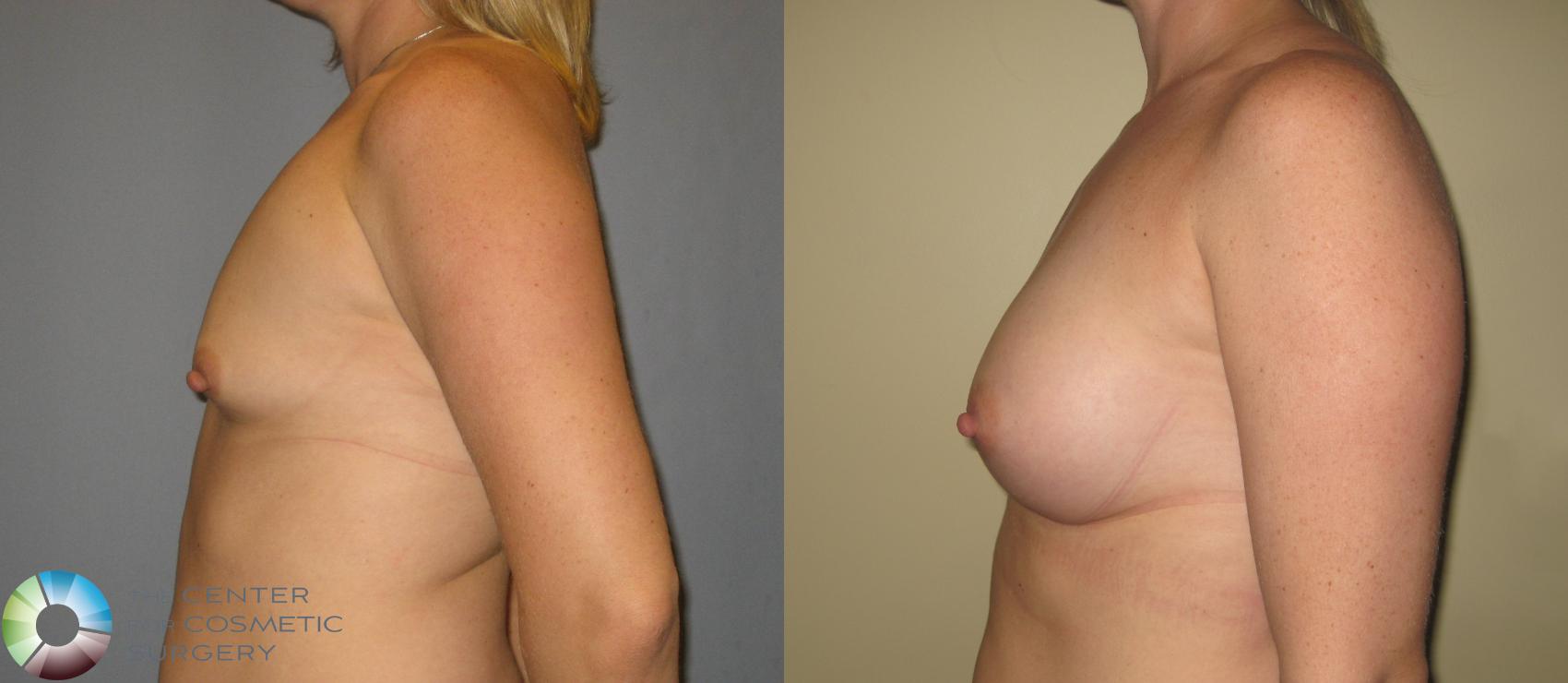 Before & After Breast Augmentation Case 371 View #3 in Denver and Colorado Springs, CO