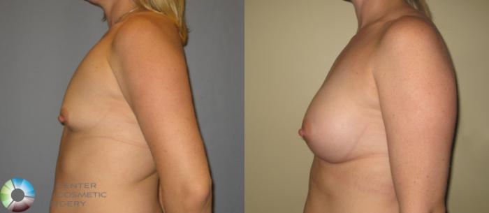 Before & After Breast Augmentation Case 371 View #3 in Denver and Colorado Springs, CO