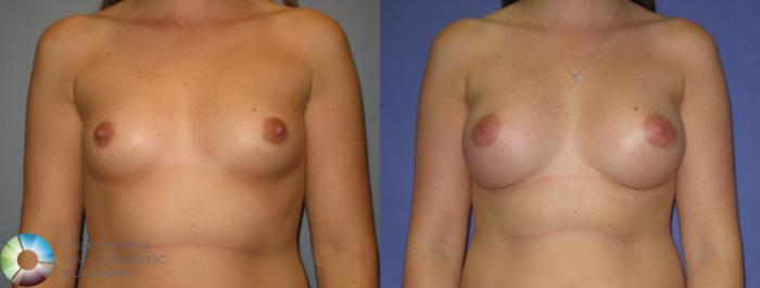 Before & After Breast Augmentation Case 372 View #1 in Denver and Colorado Springs, CO