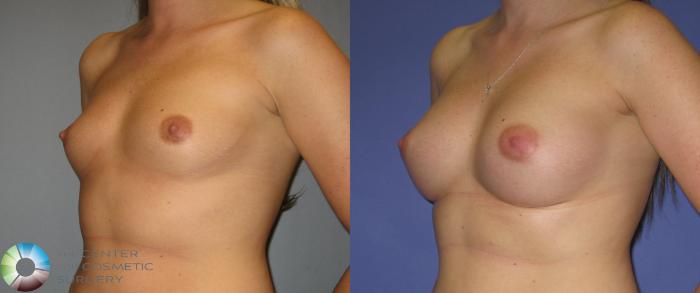 Before & After Breast Augmentation Case 372 View #2 in Denver and Colorado Springs, CO