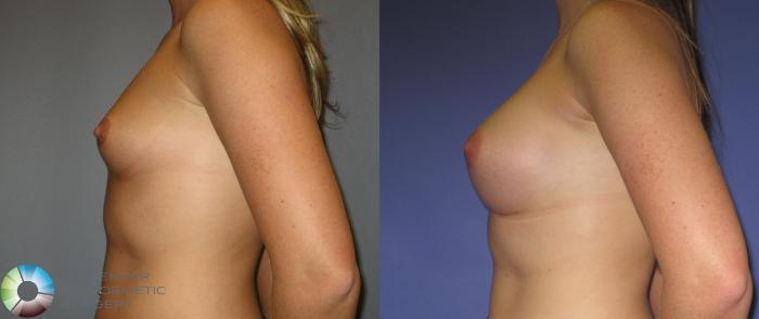 Before & After Breast Augmentation Case 372 View #3 in Denver and Colorado Springs, CO