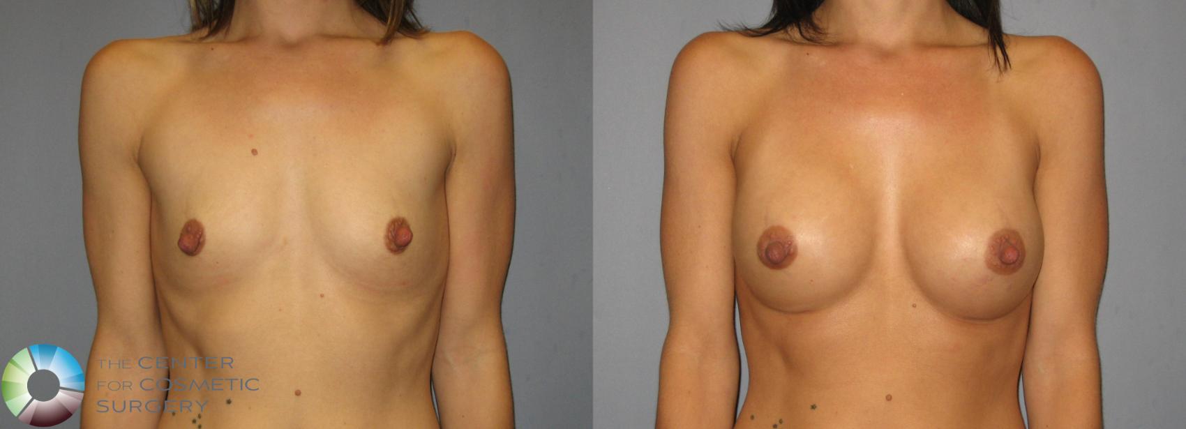 Before & After Breast Augmentation Case 376 View #1 View in Denver & Golden, CO