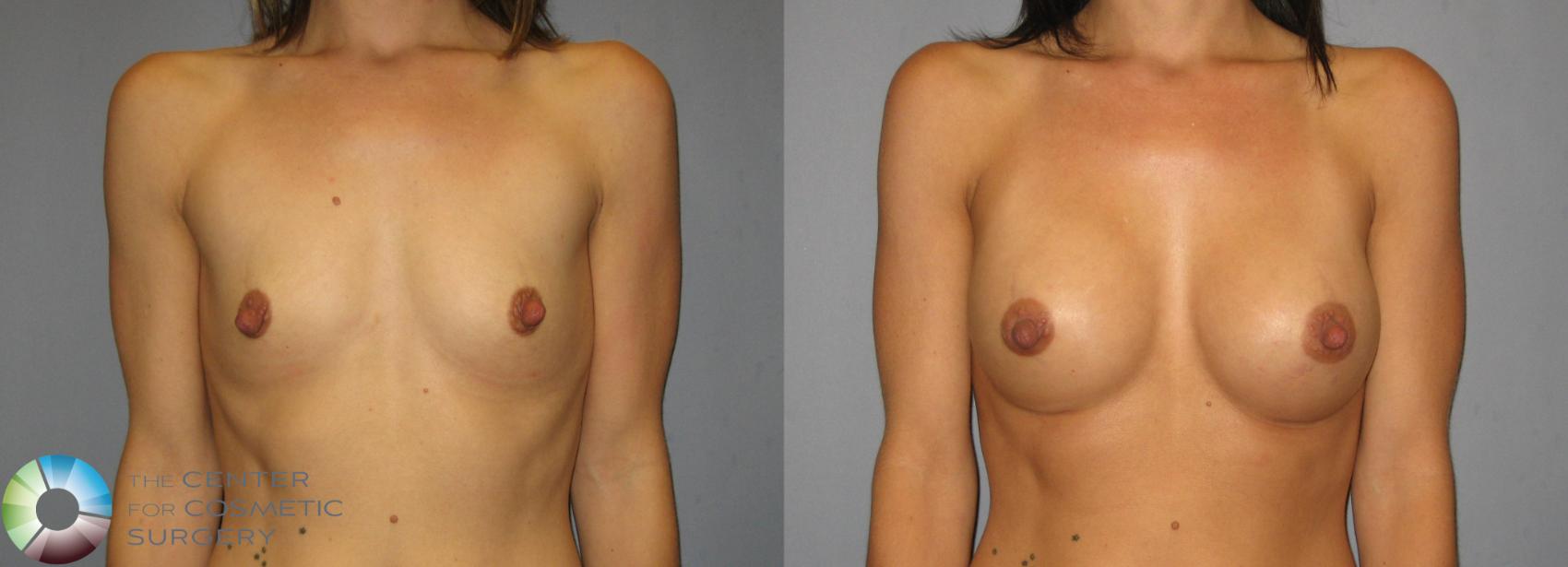 Before & After Breast Augmentation Case 376 View #1 in Denver and Colorado Springs, CO