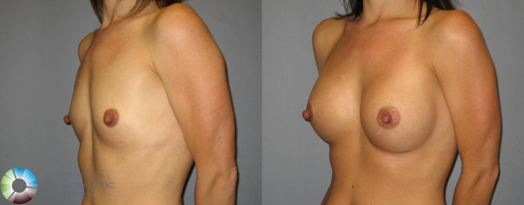 Before & After Breast Augmentation Case 376 View #2 View in Denver & Golden, CO