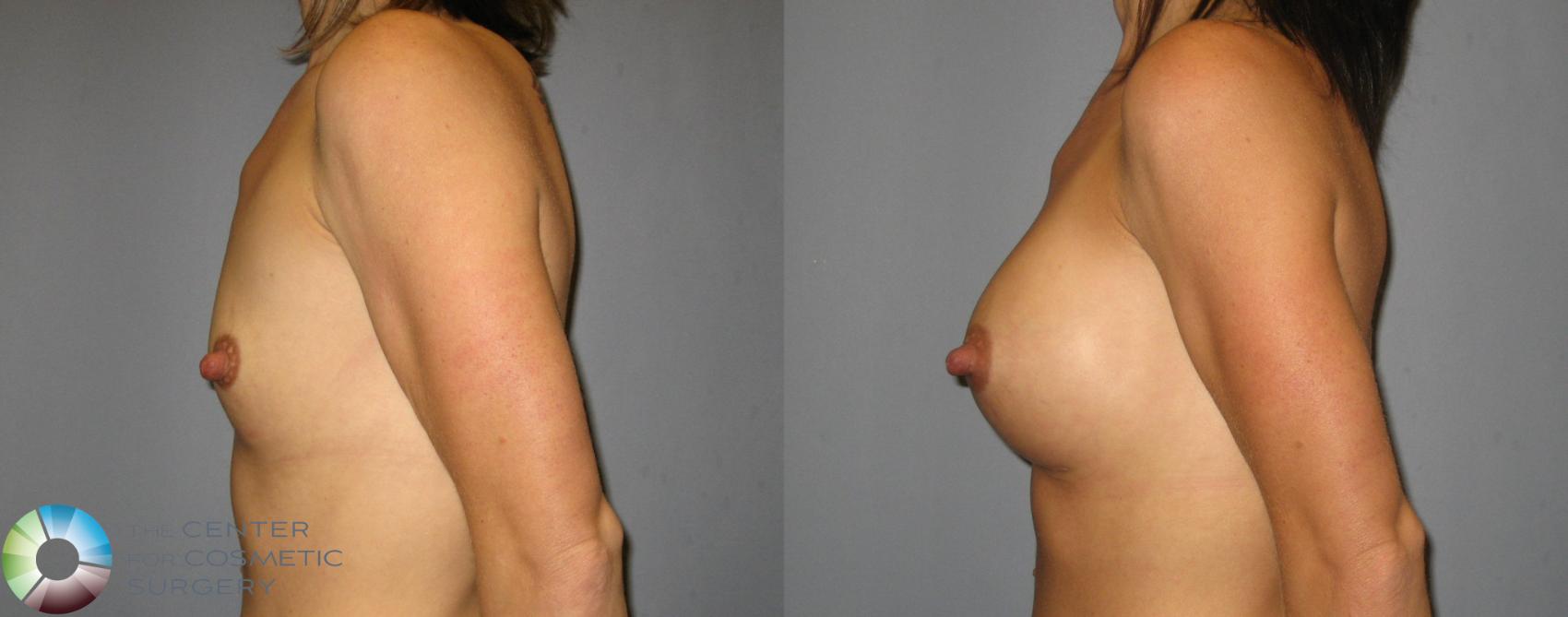 Before & After Breast Augmentation Case 376 View #3 View in Golden, CO