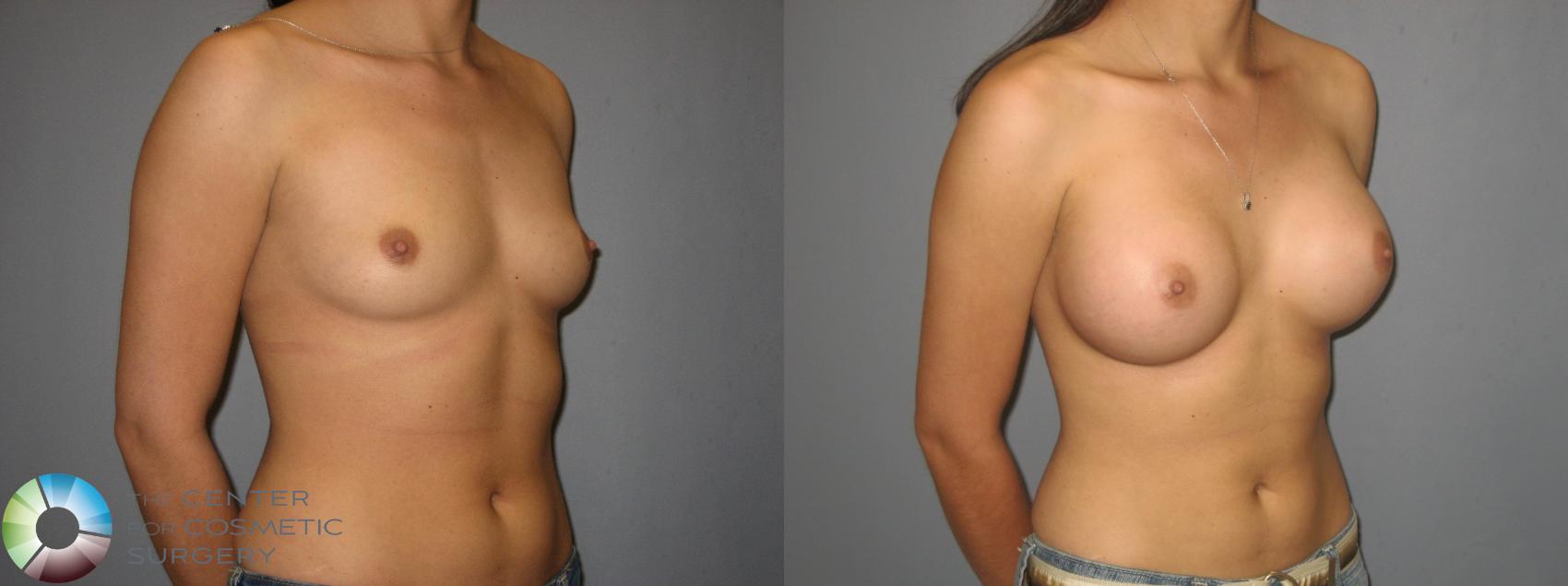 Before & After Breast Augmentation Case 379 View #1 in Denver and Colorado Springs, CO