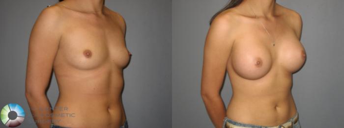 Before & After Breast Augmentation Case 379 View #1 View in Golden, CO
