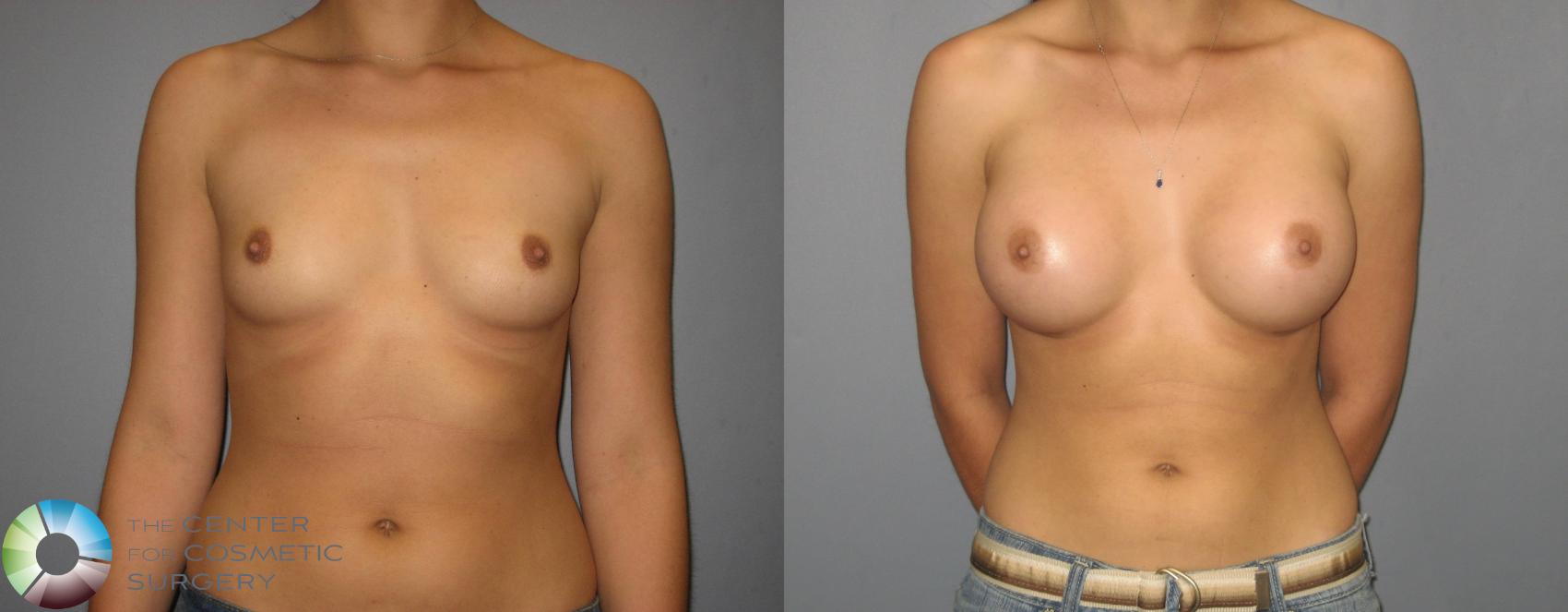 Before & After Breast Augmentation Case 379 View #2 View in Golden, CO