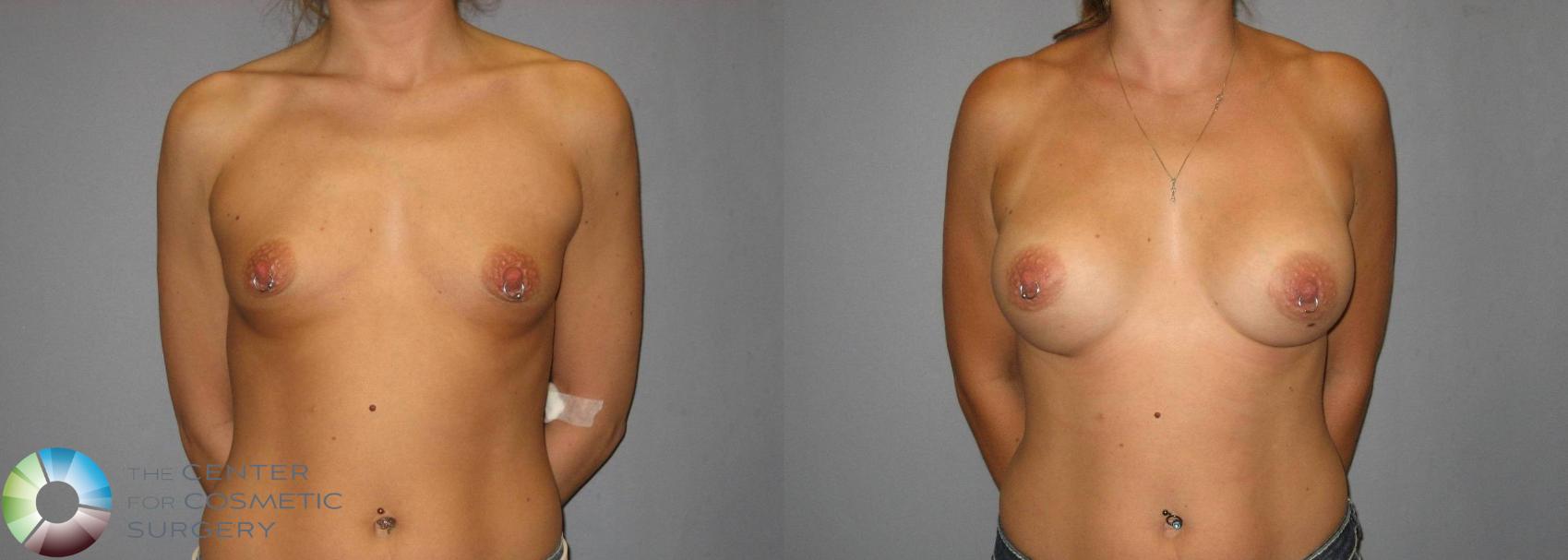 Before & After Breast Augmentation Case 380 View #1 in Denver and Colorado Springs, CO