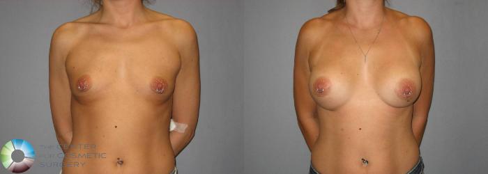 Before & After Breast Augmentation Case 380 View #1 View in Golden, CO