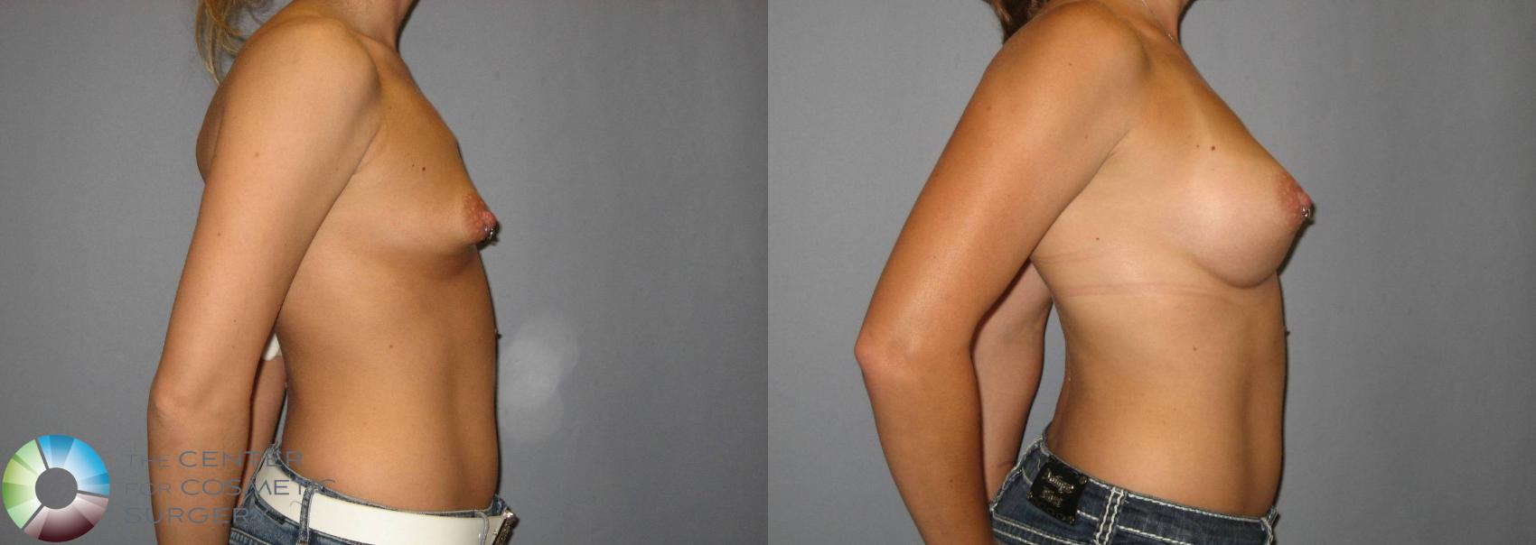 Before & After Breast Augmentation Case 380 View #2 View in Golden, CO