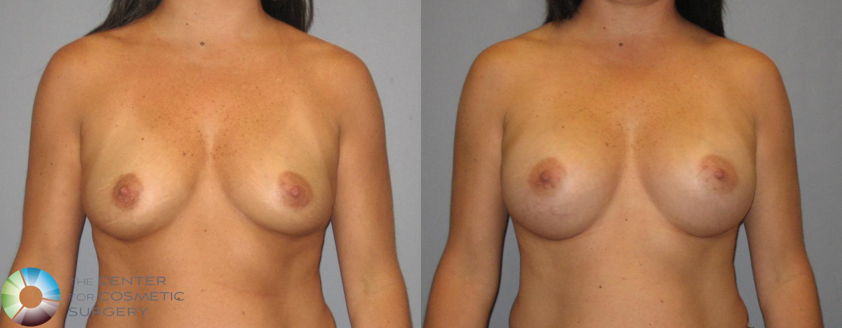 Before & After Breast Augmentation Case 387 View #1 View in Golden, CO