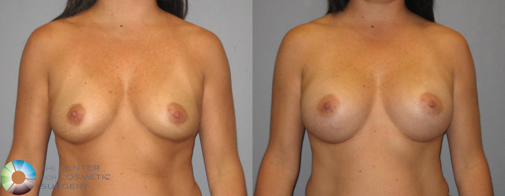 Before & After Breast Augmentation Case 387 View #1 in Denver and Colorado Springs, CO