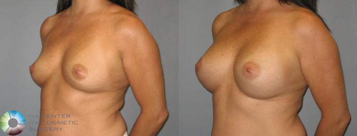 Before & After Breast Augmentation Case 387 View #2 View in Golden, CO