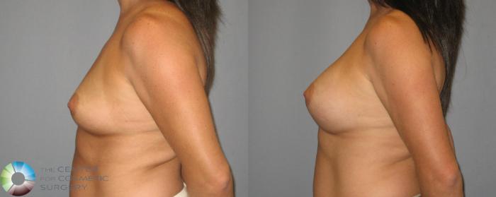 Before & After Breast Augmentation Case 387 View #3 View in Golden, CO