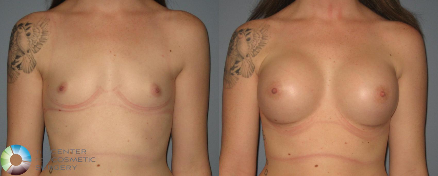 Before & After Breast Augmentation Case 397 View #1 in Denver and Colorado Springs, CO