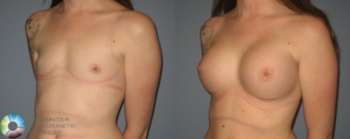 Before & After Breast Augmentation Case 397 View #2 View in Golden, CO