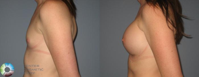 Before & After Breast Augmentation Case 397 View #3 View in Golden, CO