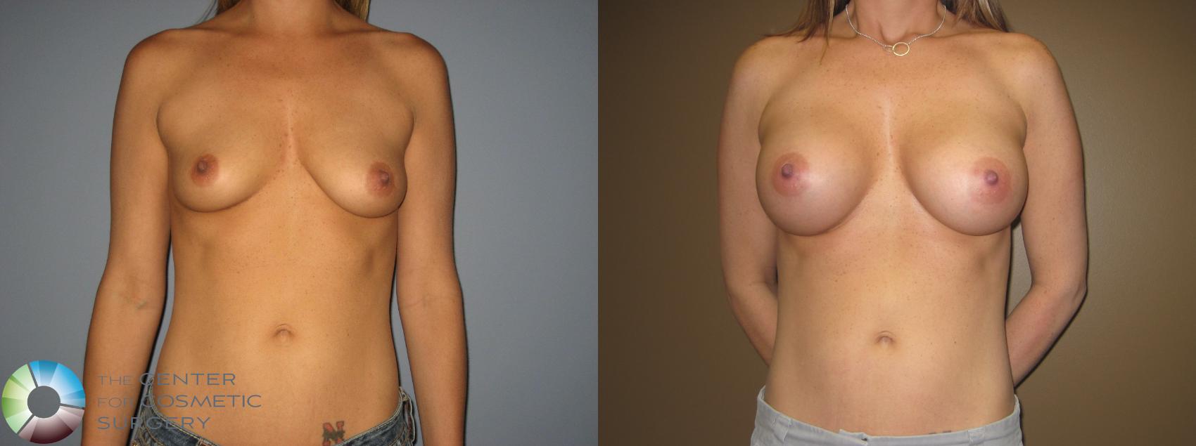 Before & After Breast Augmentation Case 399 View #1 in Denver, CO