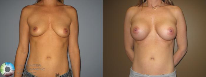 Before & After Breast Augmentation Case 399 View #1 in Denver, CO