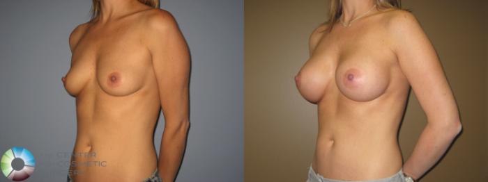 Before & After Breast Augmentation Case 399 View #2 in Denver, CO