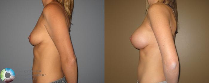 Before & After Breast Augmentation Case 399 View #3 in Denver, CO