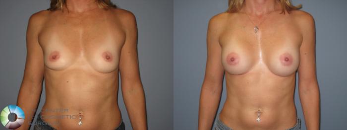 Before & After Breast Augmentation Case 400 View #1 View in Golden, CO