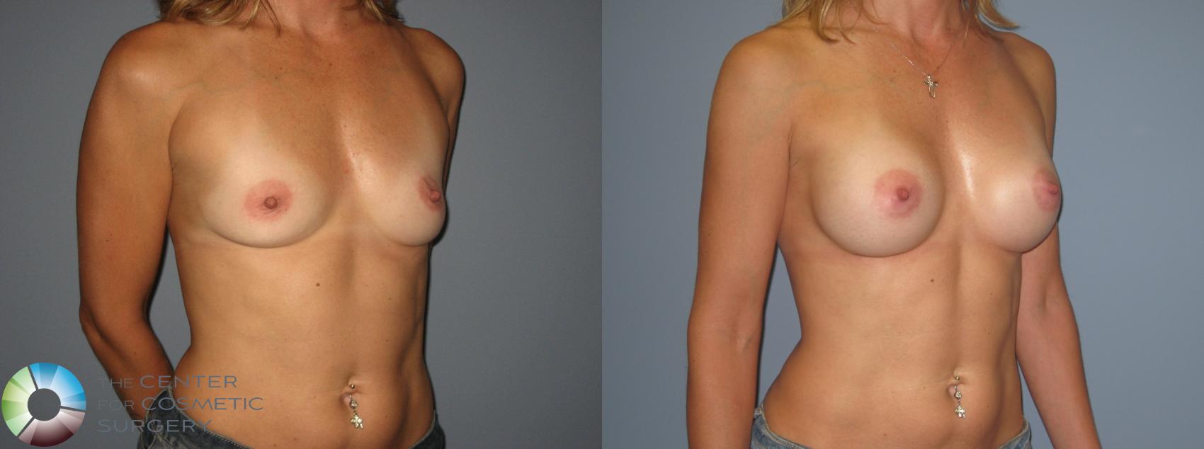 Before & After Breast Augmentation Case 400 View #2 in Denver and Colorado Springs, CO