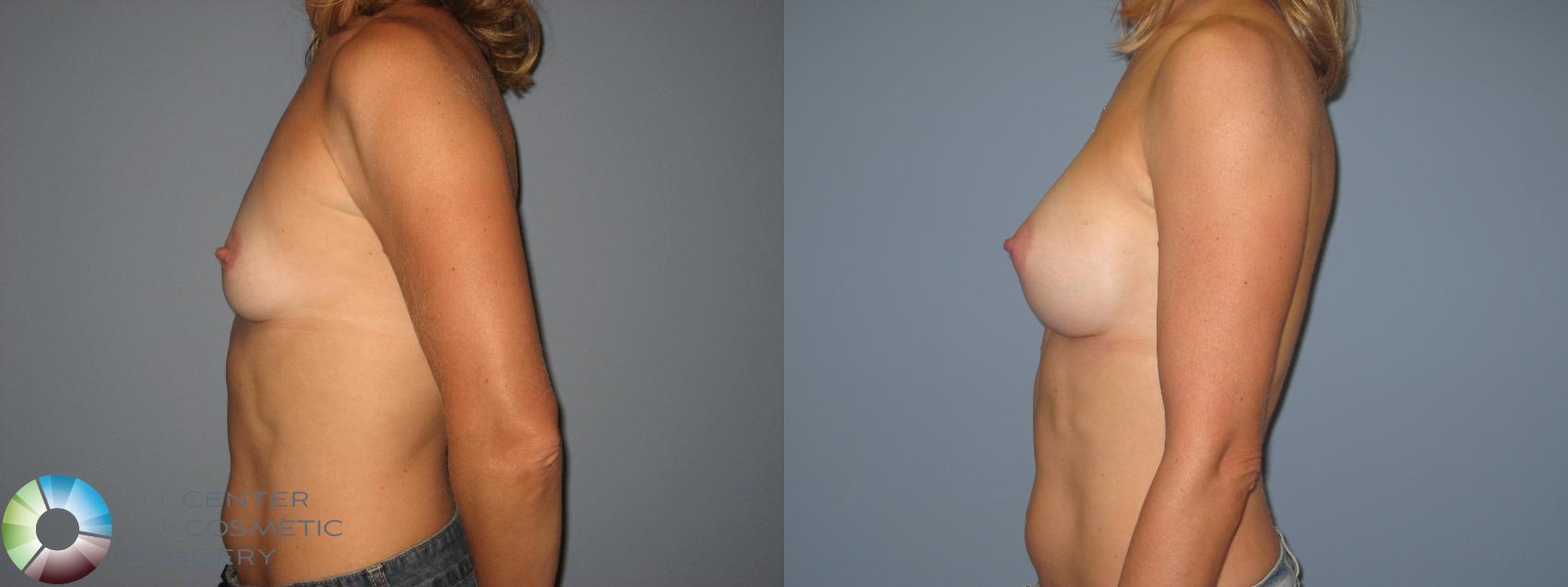 Before & After Breast Augmentation Case 400 View #3 in Denver and Colorado Springs, CO