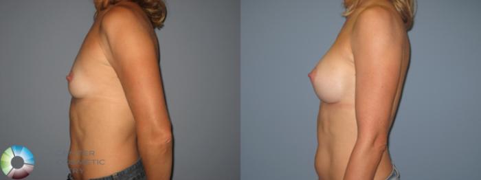 Before & After Breast Augmentation Case 400 View #3 View in Golden, CO