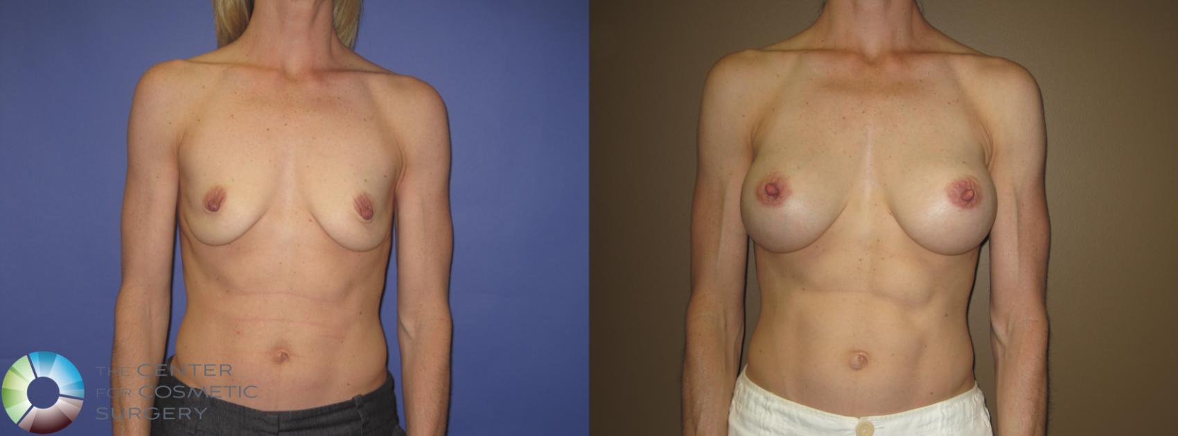 Before & After Breast Augmentation Case 407 View #1 in Denver and Colorado Springs, CO