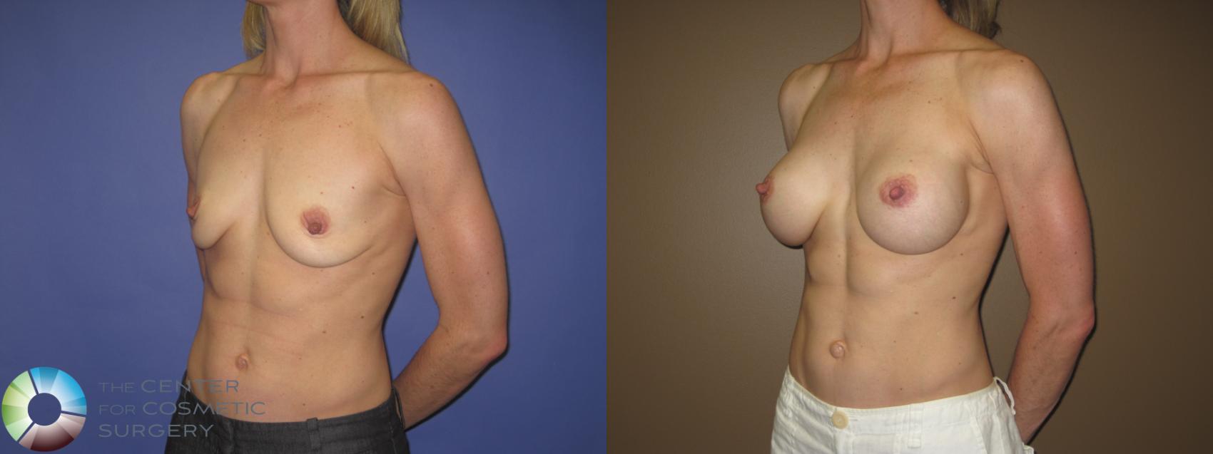 Before & After Breast Augmentation Case 407 View #2 View in Golden, CO