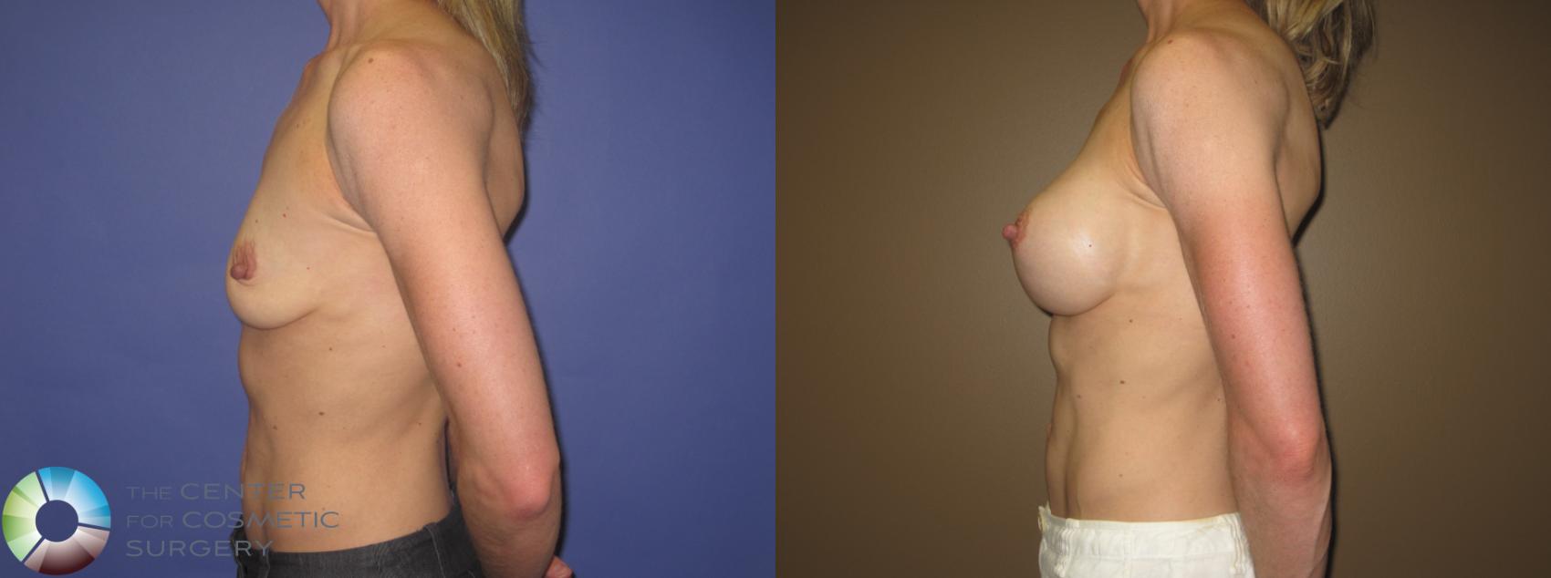 Before & After Breast Augmentation Case 407 View #3 View in Denver & Golden, CO