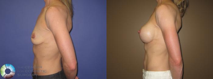 Before & After Breast Augmentation Case 407 View #3 View in Golden, CO