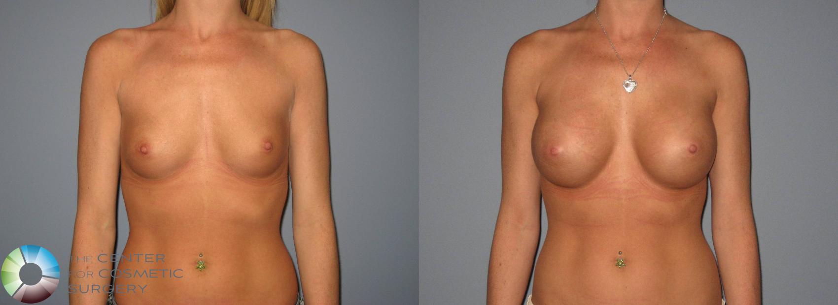 Before & After Breast Augmentation Case 408 View #1 in Denver, CO