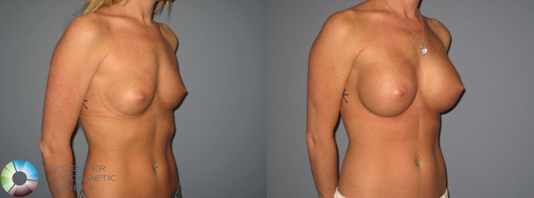 Before & After Breast Augmentation Case 408 View #2 View in Golden, CO