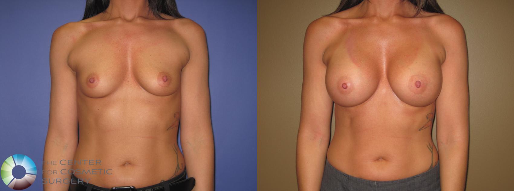 Before & After Breast Augmentation Case 410 View #1 in Denver and Colorado Springs, CO