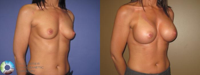 Before & After Breast Augmentation Case 410 View #2 View in Golden, CO