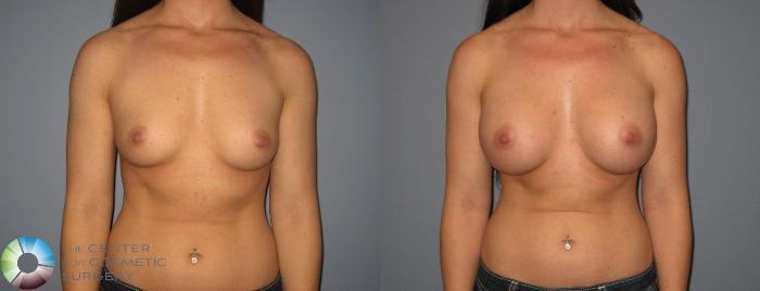 Before & After Breast Augmentation Case 411 View #1 in Denver and Colorado Springs, CO