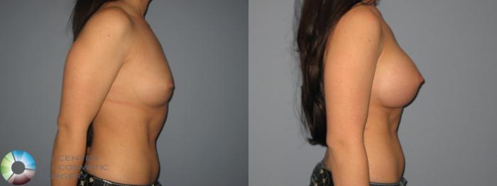 Before & After Breast Augmentation Case 411 View #2 in Denver and Colorado Springs, CO