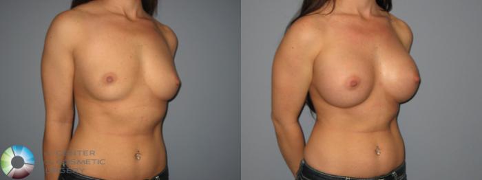 Before & After Breast Augmentation Case 411 View #3 in Denver and Colorado Springs, CO