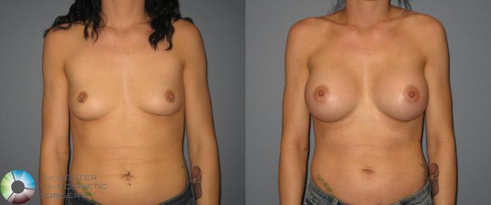 Before & After Breast Augmentation Case 412 View #1 in Denver, CO