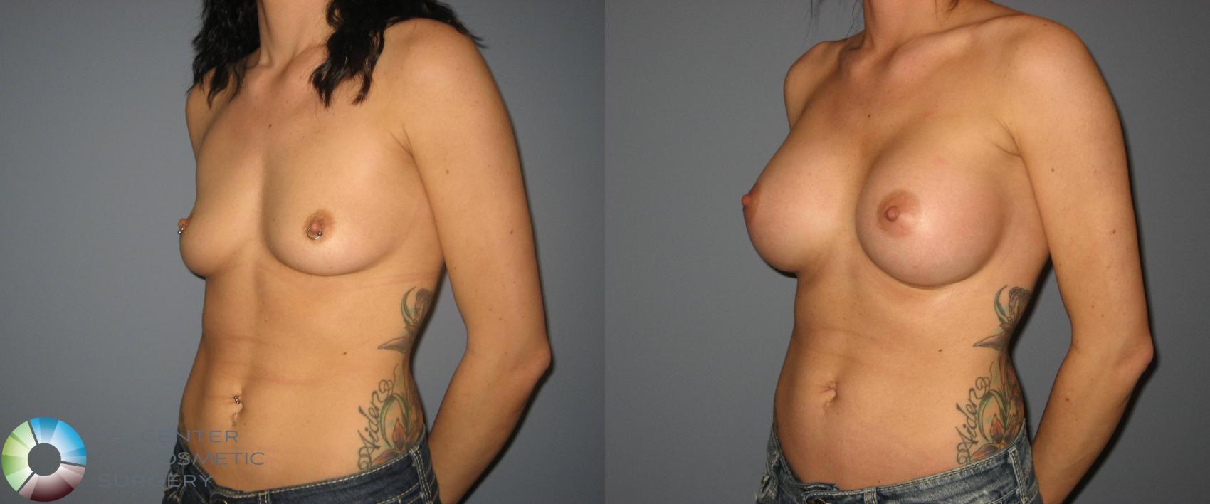 Before & After Breast Augmentation Case 412 View #2 in Denver and Colorado Springs, CO
