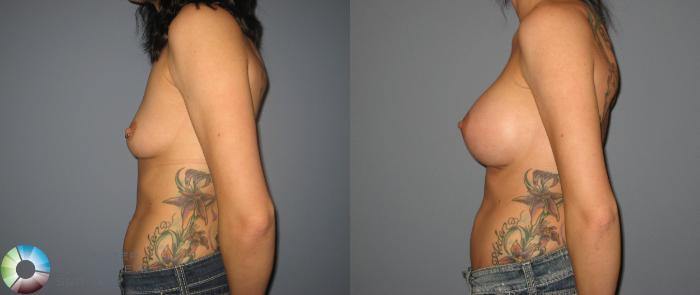 Before & After Breast Augmentation Case 412 View #3 in Denver, CO
