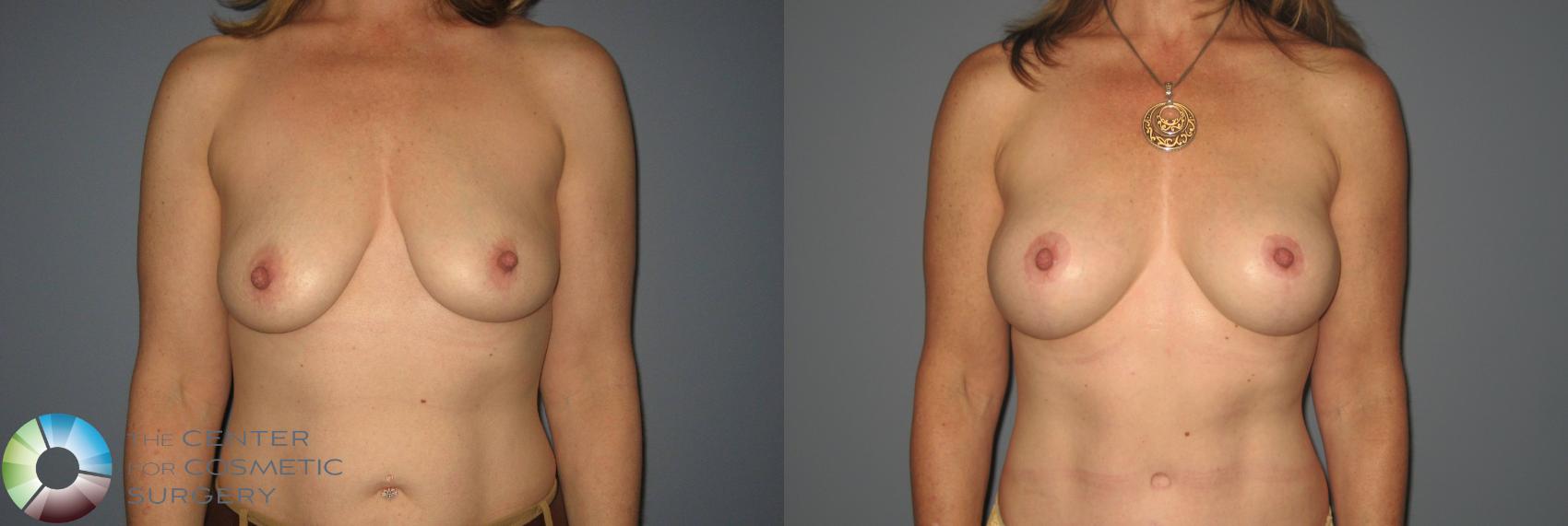 Before & After Breast Augmentation Case 414 View #1 View in Golden, CO