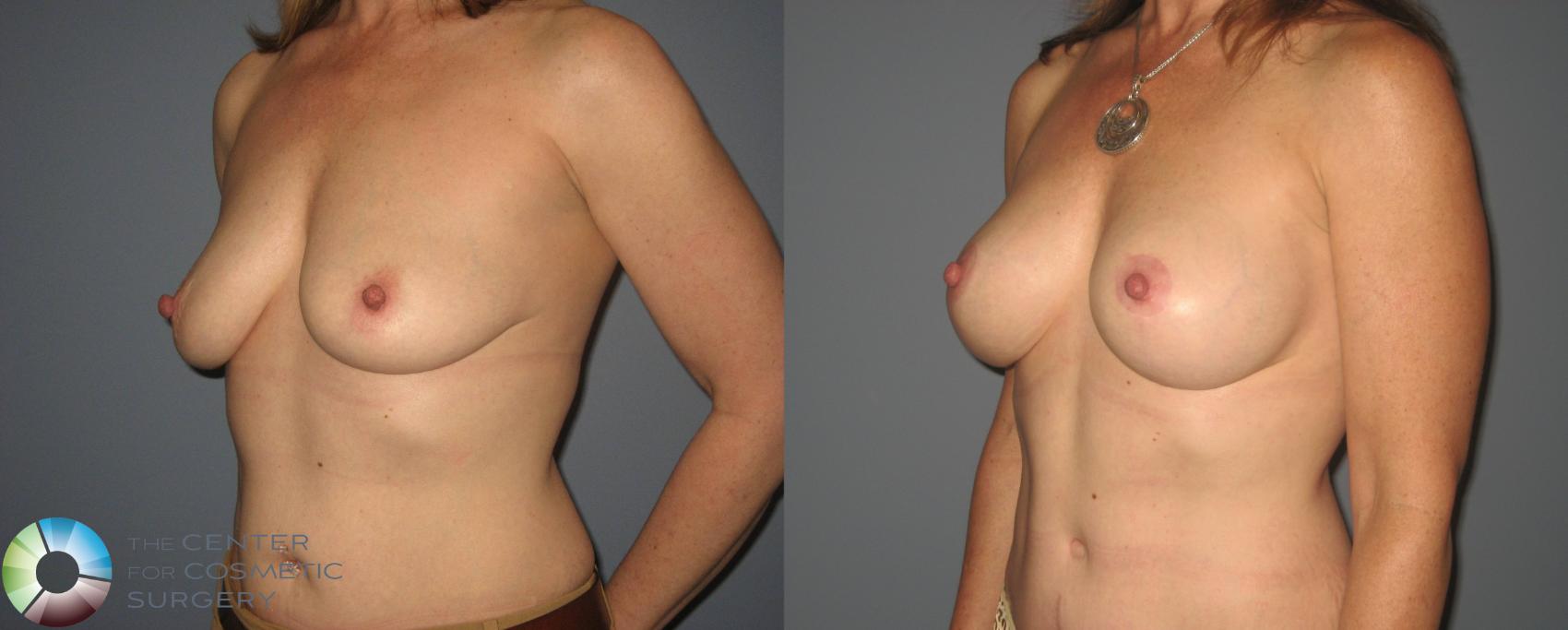 Before & After Breast Augmentation Case 414 View #2 in Denver and Colorado Springs, CO